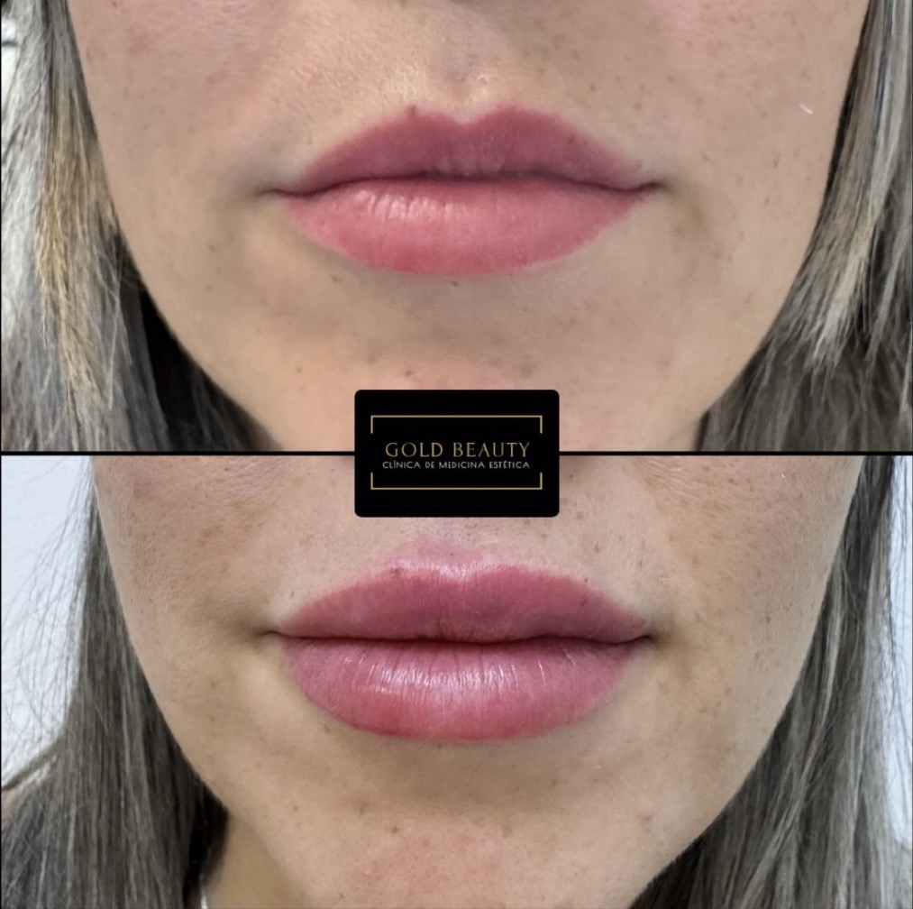 Antes y después de un aumento de labios, caso 1