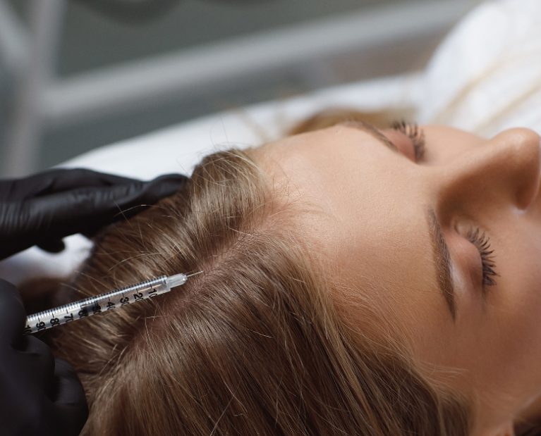 carboxiterapia-capilar-madrid